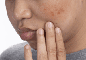 Spot Treatments