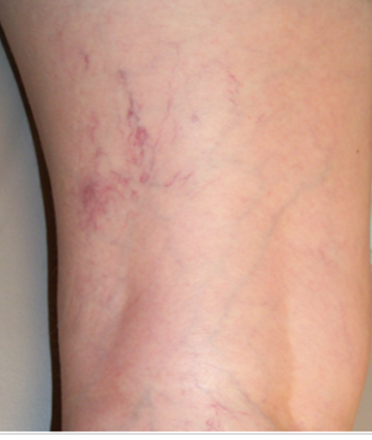 What Are Spider Veins? img 1