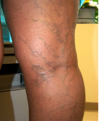 What Are Spider Veins? img 2