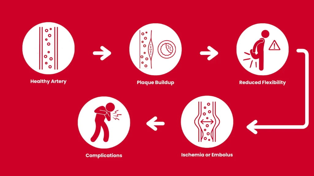 How Does Peripheral Arterial Disease Occur