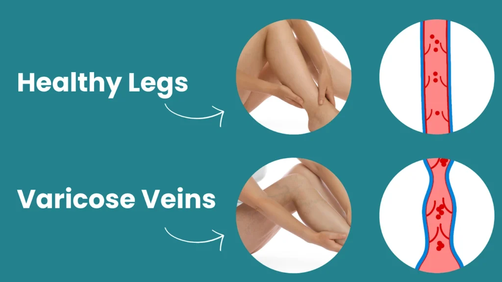 healthy legs and varicose veins