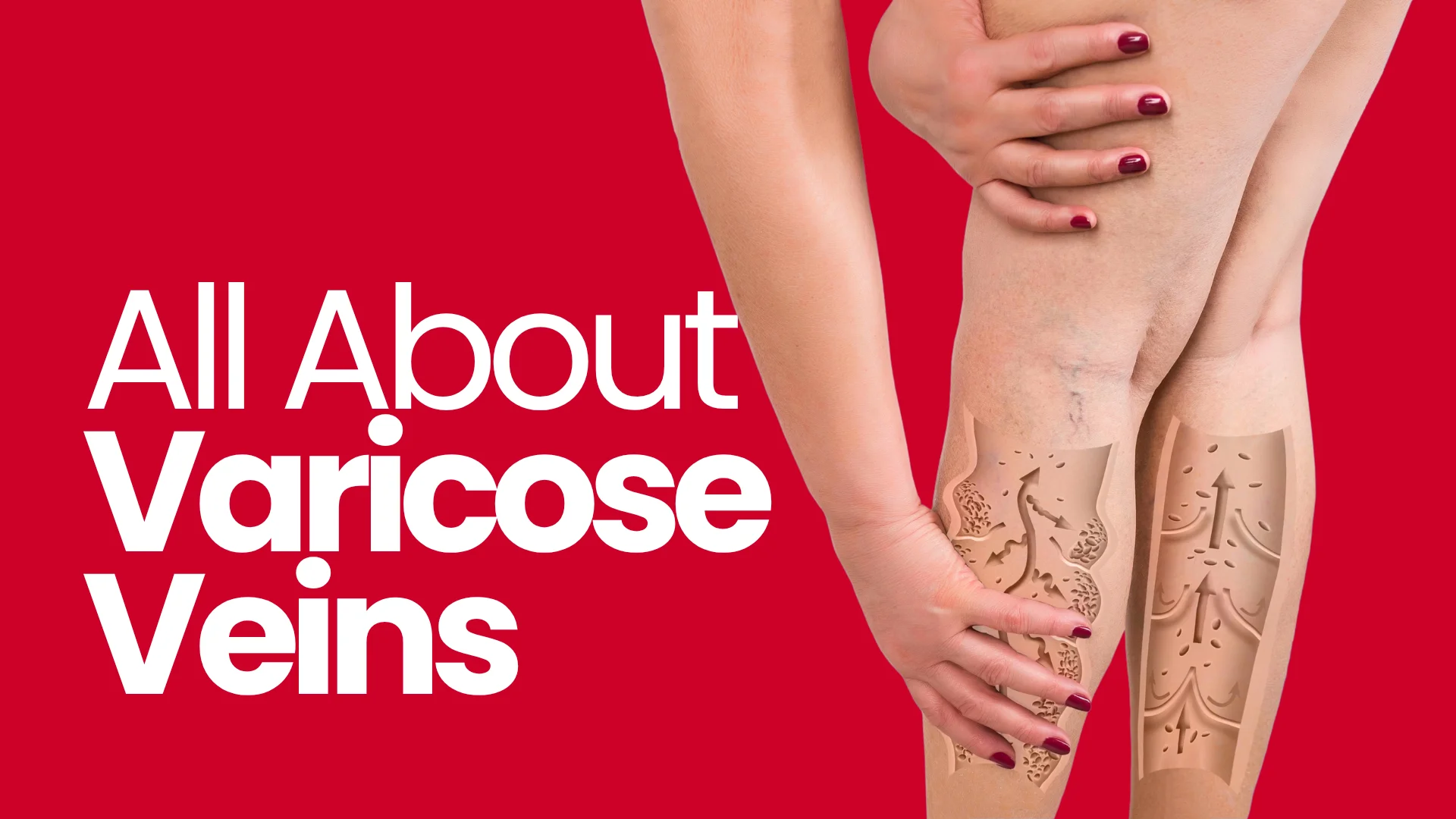 All About Varicose Veins