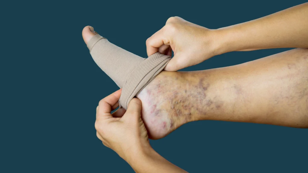 Are Varicose Veins Dangerous