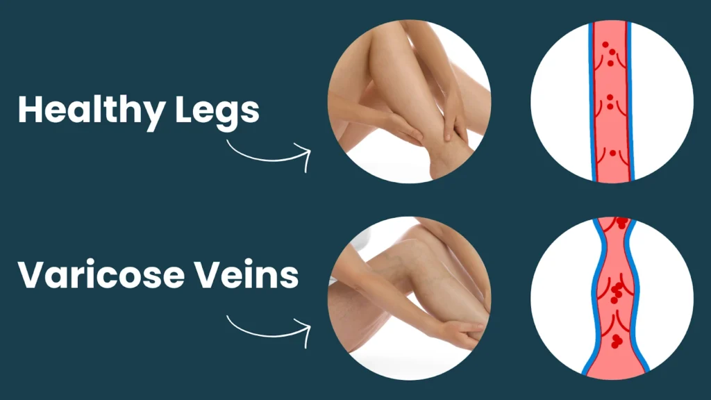 Chronic Venous Insufficiency Symptoms