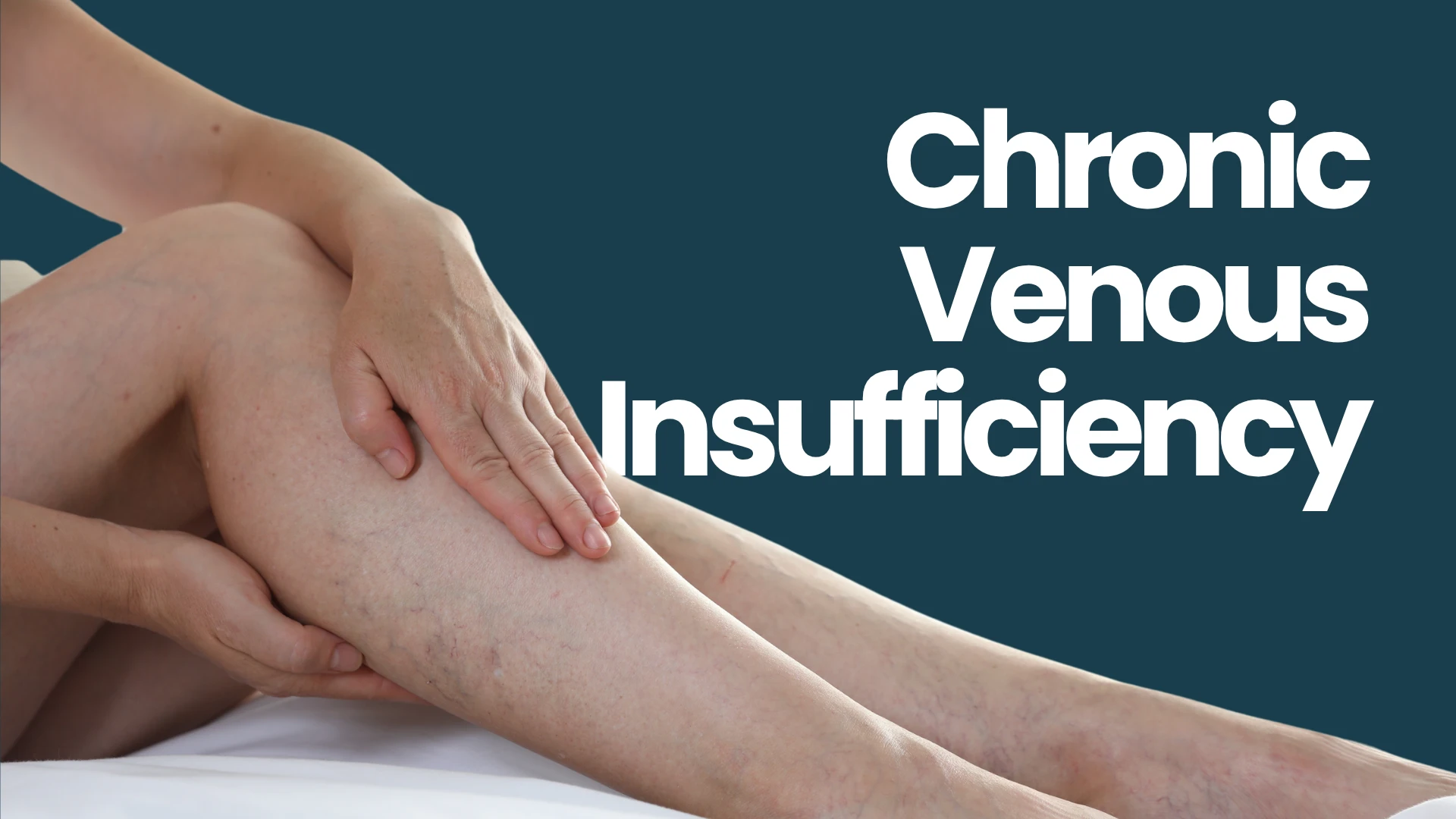 Chronic Venous Insufficiency