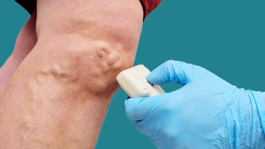 Treating Varicose Veins