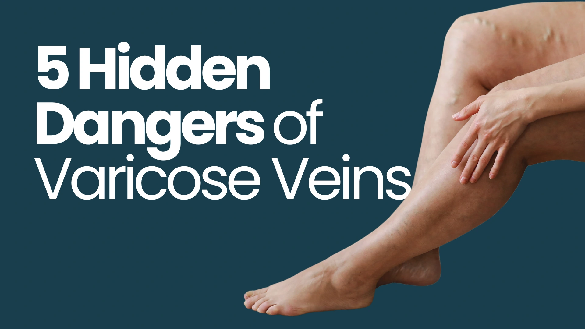 5 Hidden Dangers of Varicose Veins