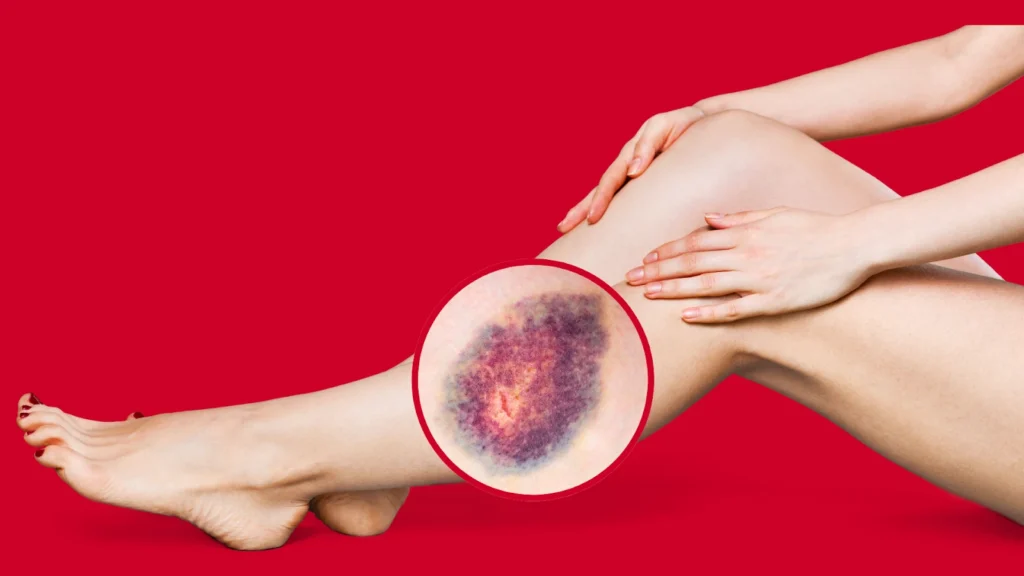 Varicose Eczema TVS