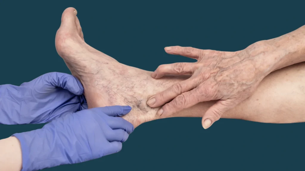 varicose ventis treatment