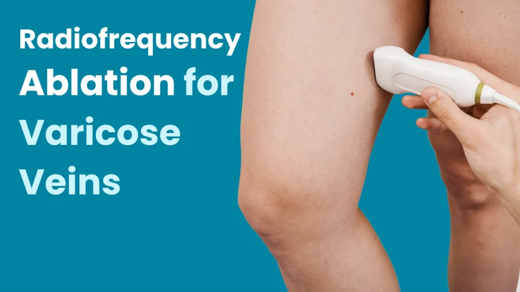 Radiofrequency Ablation for Varicose Veins