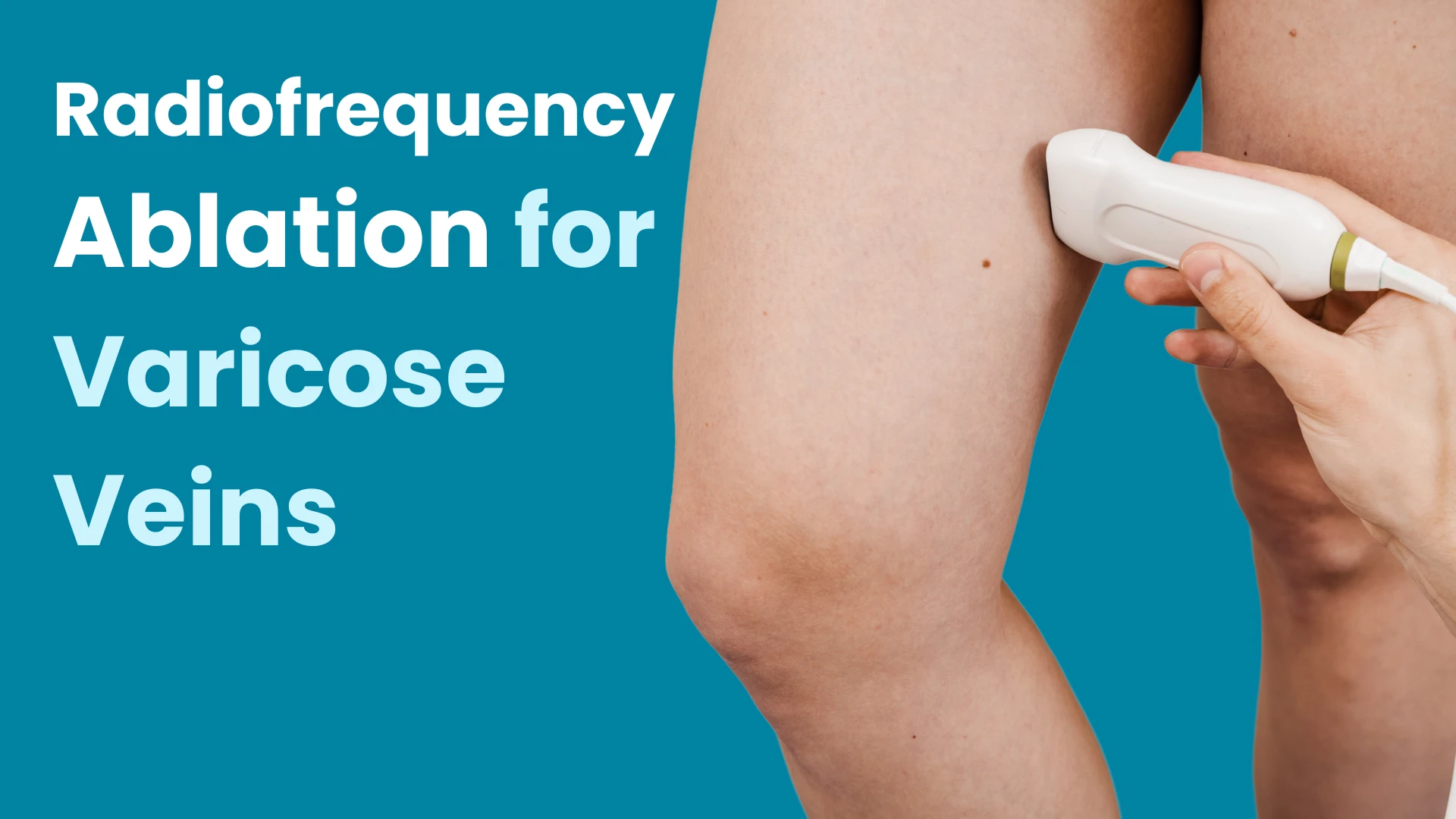 Radiofrequency Ablation for Varicose Veins