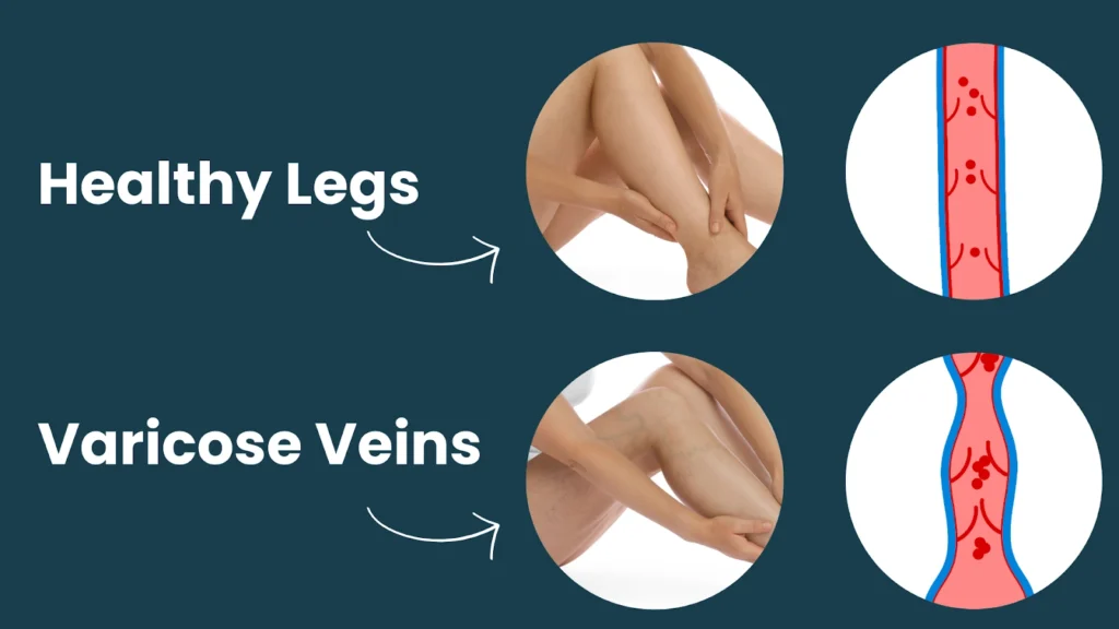healthy legs and varicose veins
