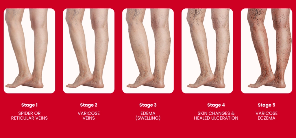 stages of varicose veins