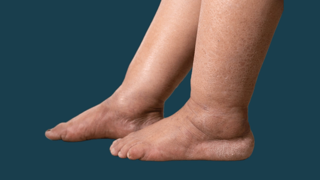 Swelling Around Ankles and Legs