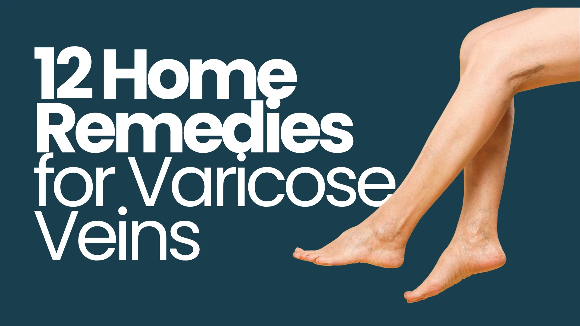12 Home Remedies for Varicose Veins