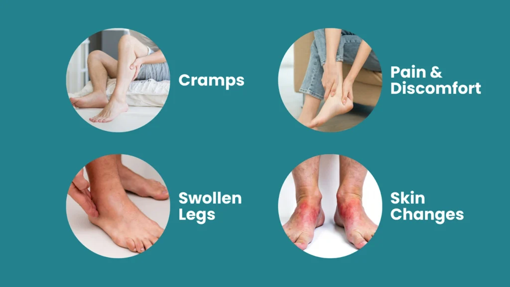 How Do Varicose Veins Develop