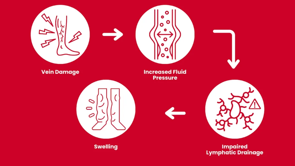 Common Vein Conditions and Lymphedema