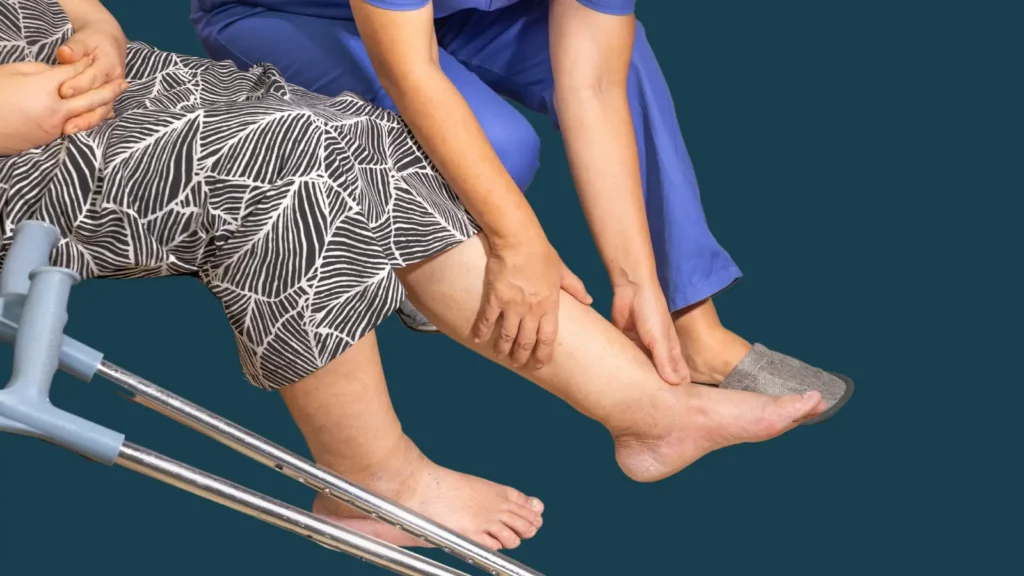 Lymphedema Diagnosis
