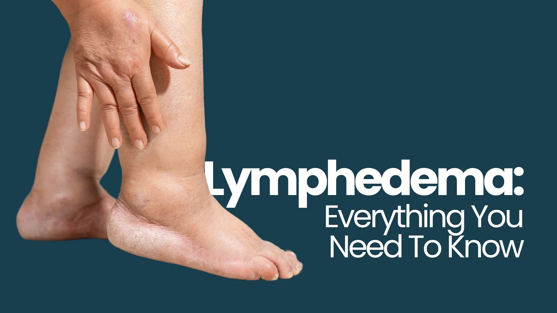 Lymphedema Everything You Need To Know