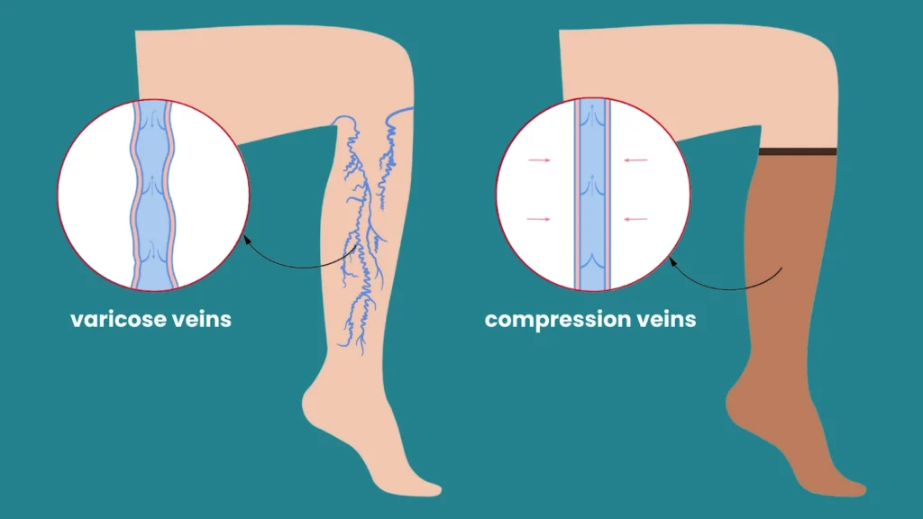 Compression Therapy