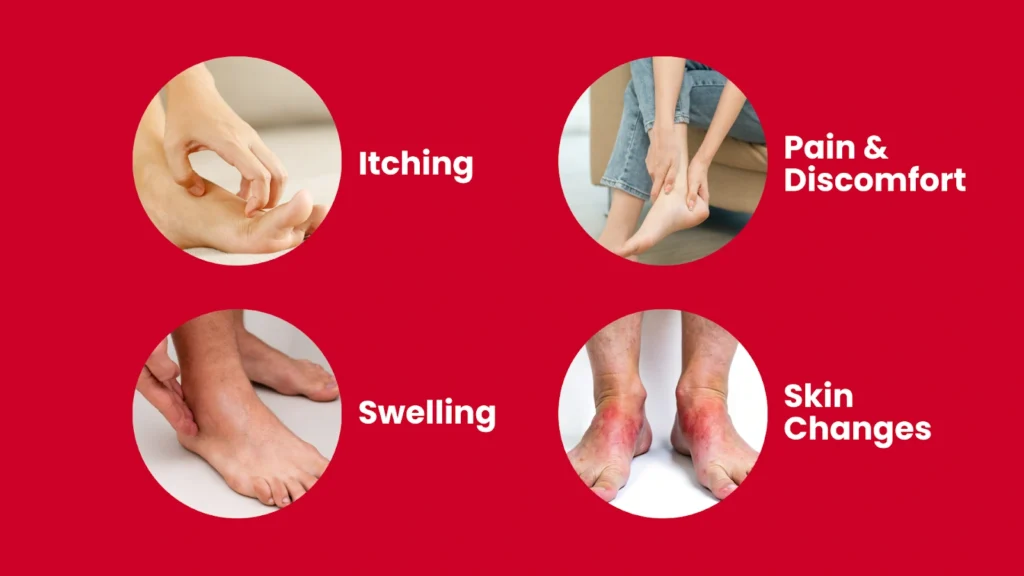Venous Ulcers Symptoms