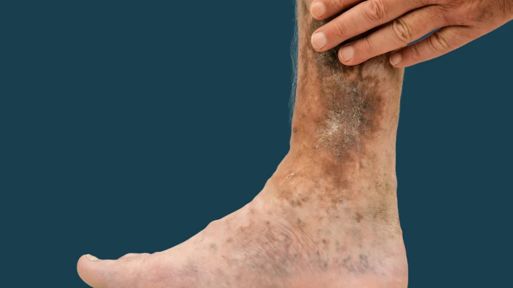 venous ulcers man
