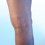 Spider Veins