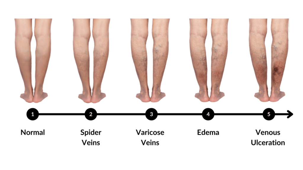 Vein Progression