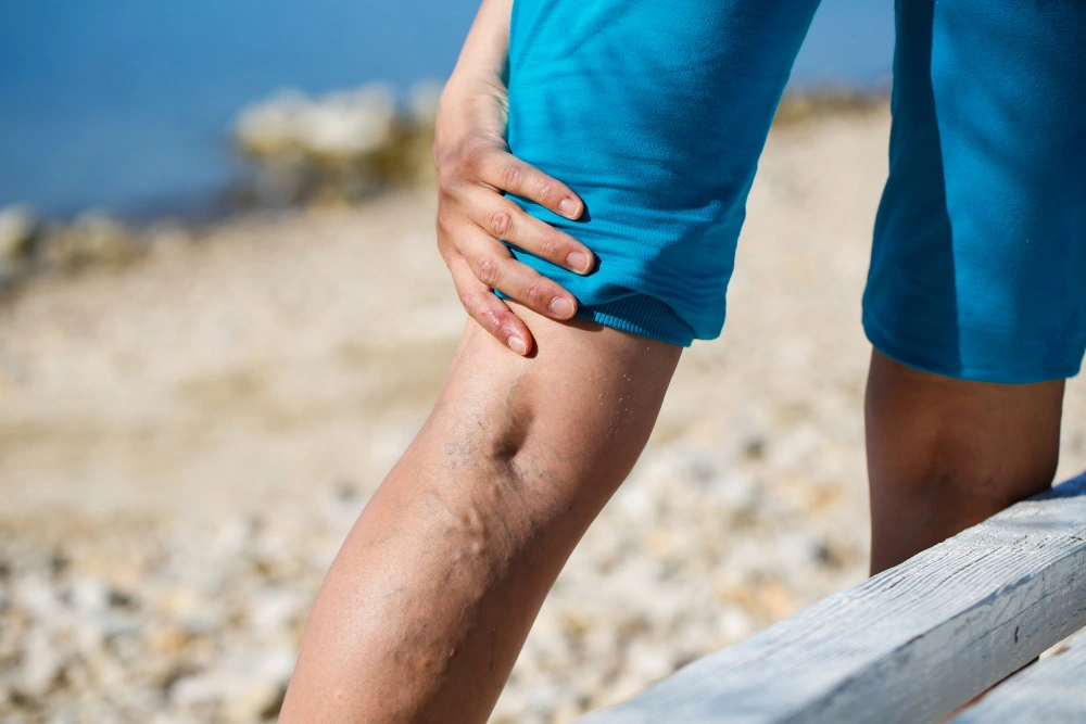Understanding Your Varicose Vein Treatment Options