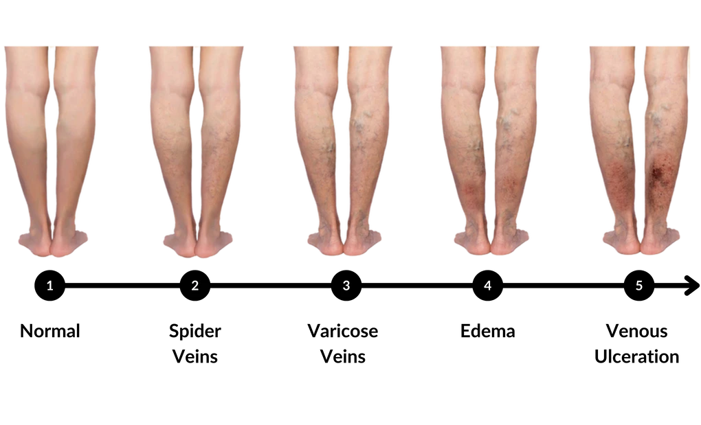 Treatment for Varicose Veins