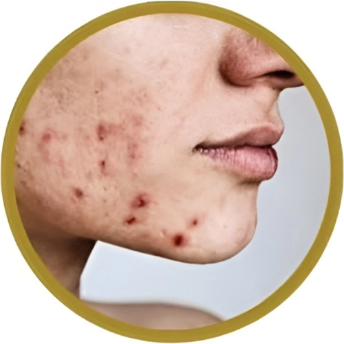 Acne Scarring and Damage​