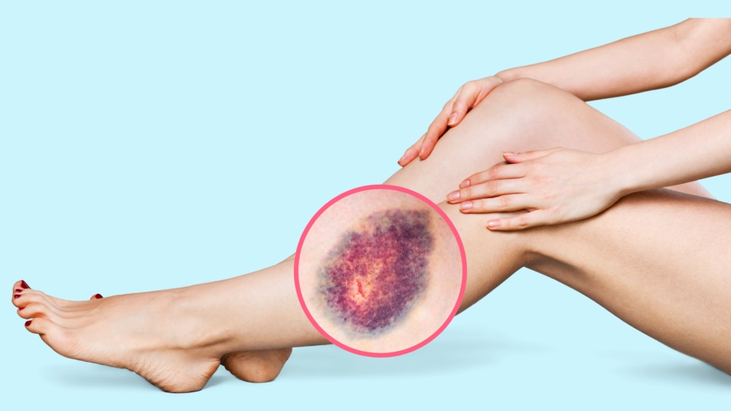 Ulcers