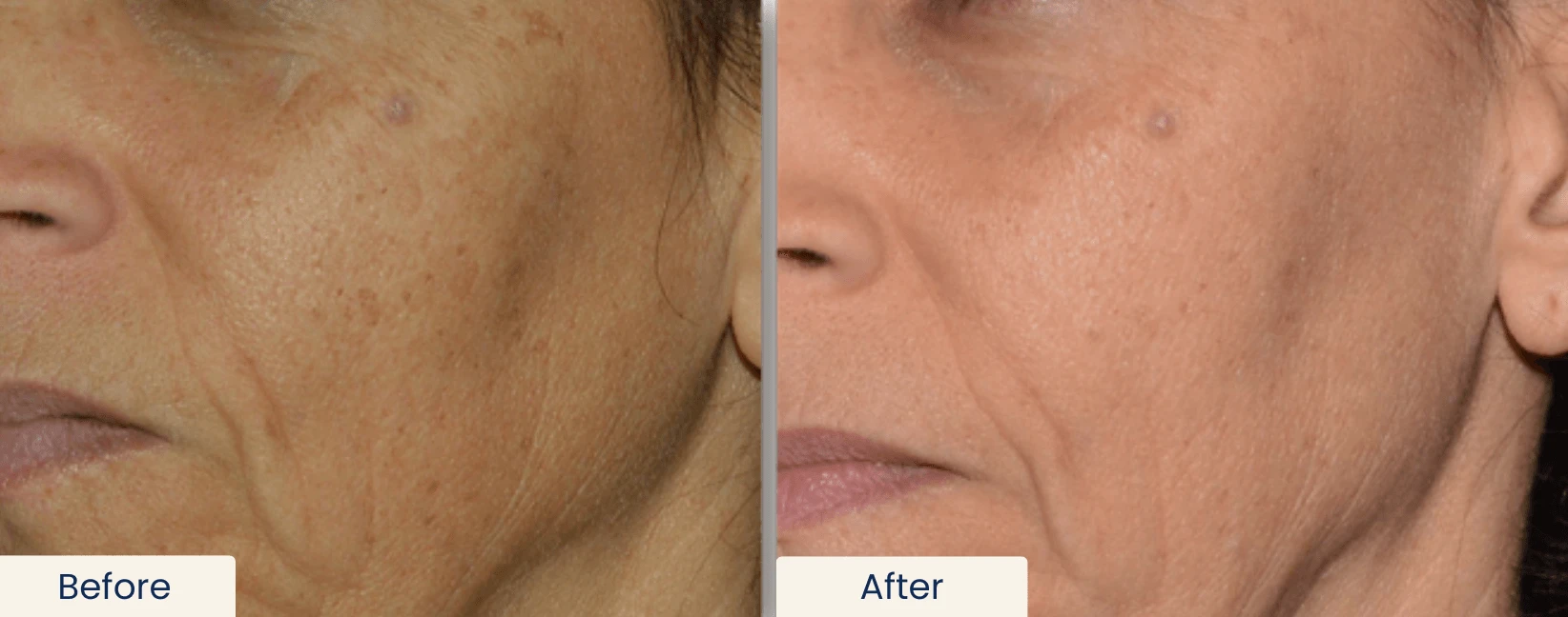 before and after result
