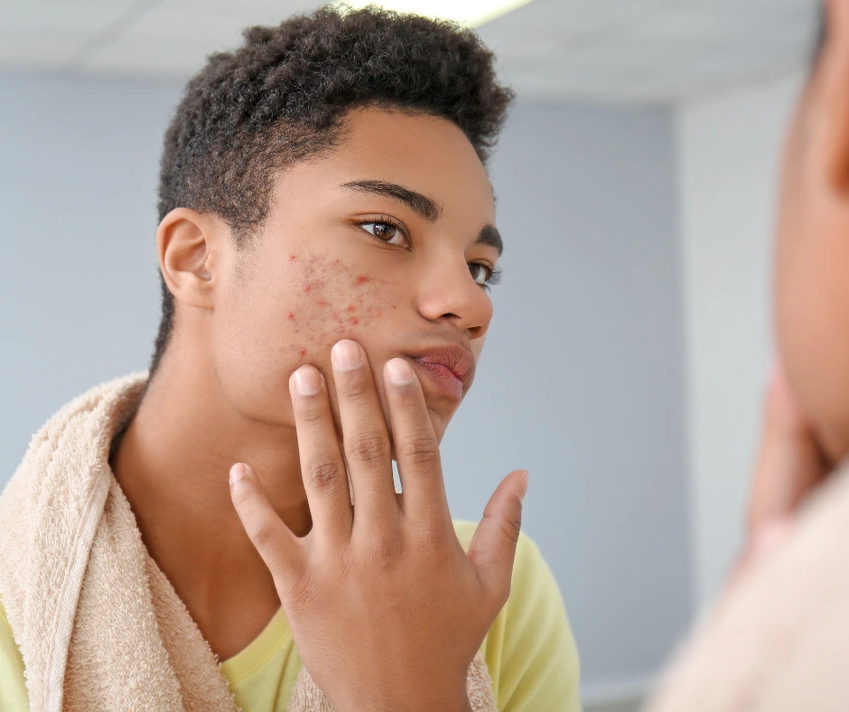 man face with pimples